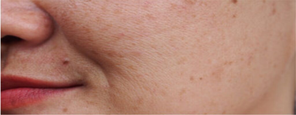 Before - Best Medi Facials in Pune