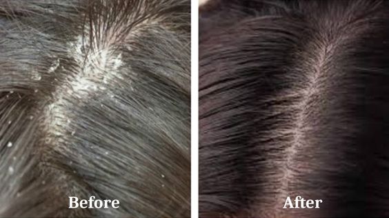 Dandruff Treatment4 Flawless 4 Ever Dandruff Treatment Dandruff Treatment