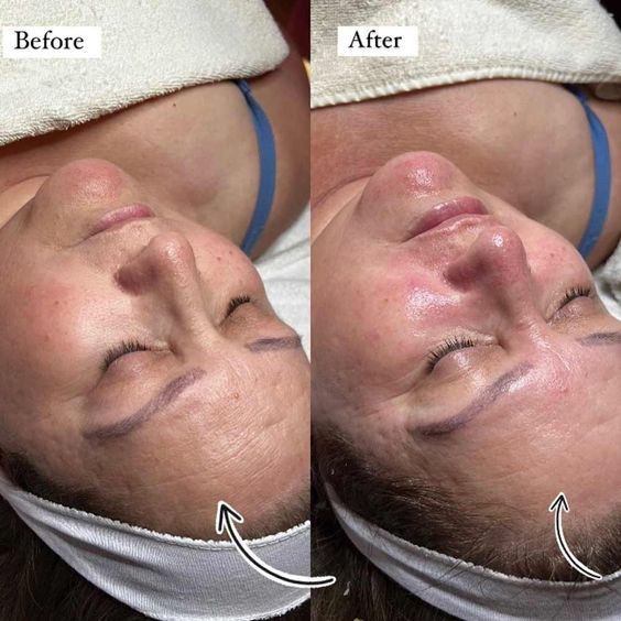 Derma Chemical Peel1 Flawless 4 Ever Derma Chemical Peel Derma Chemical Peel