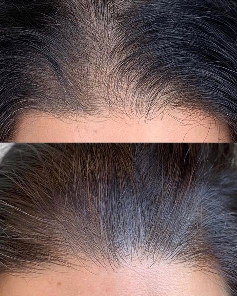 Hair Mesotherapy1 Flawless 4 Ever Hair Mesotherapy Hair Mesotherapy