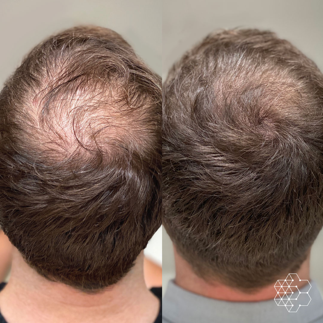 The Ultimate Guide to Hair Growth Therapy at Flawless4Ever