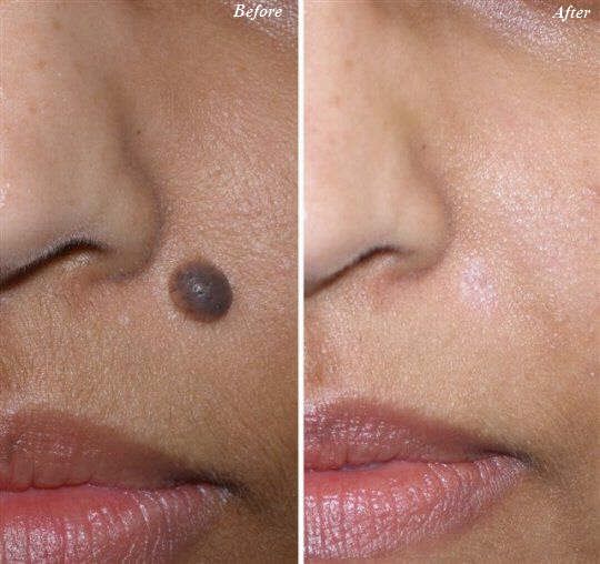 Moles Removal1 Flawless 4 Ever Moles Removal Moles Removal