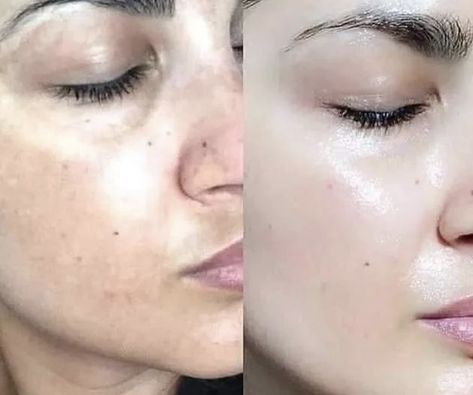 Moles Removal3 Flawless 4 Ever Moles Removal Moles Removal