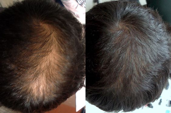 PRP Hair Loss Treatment2 Flawless 4 Ever PRP Hair Loss Treatment PRP Hair Loss Treatment