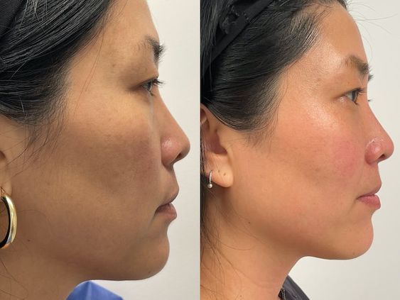 Skin Tightening1 Flawless 4 Ever Skin Tightening Skin Tightening