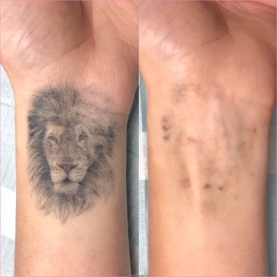 Tattoo Removal1 Flawless 4 Ever Tattoo Removal Tattoo Removal