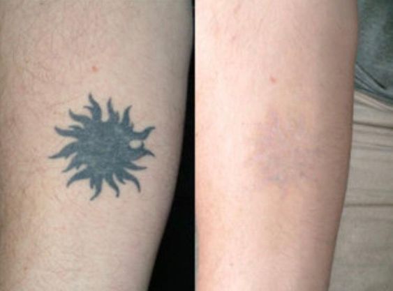 Tattoo Removal2 Flawless 4 Ever Tattoo Removal Tattoo Removal