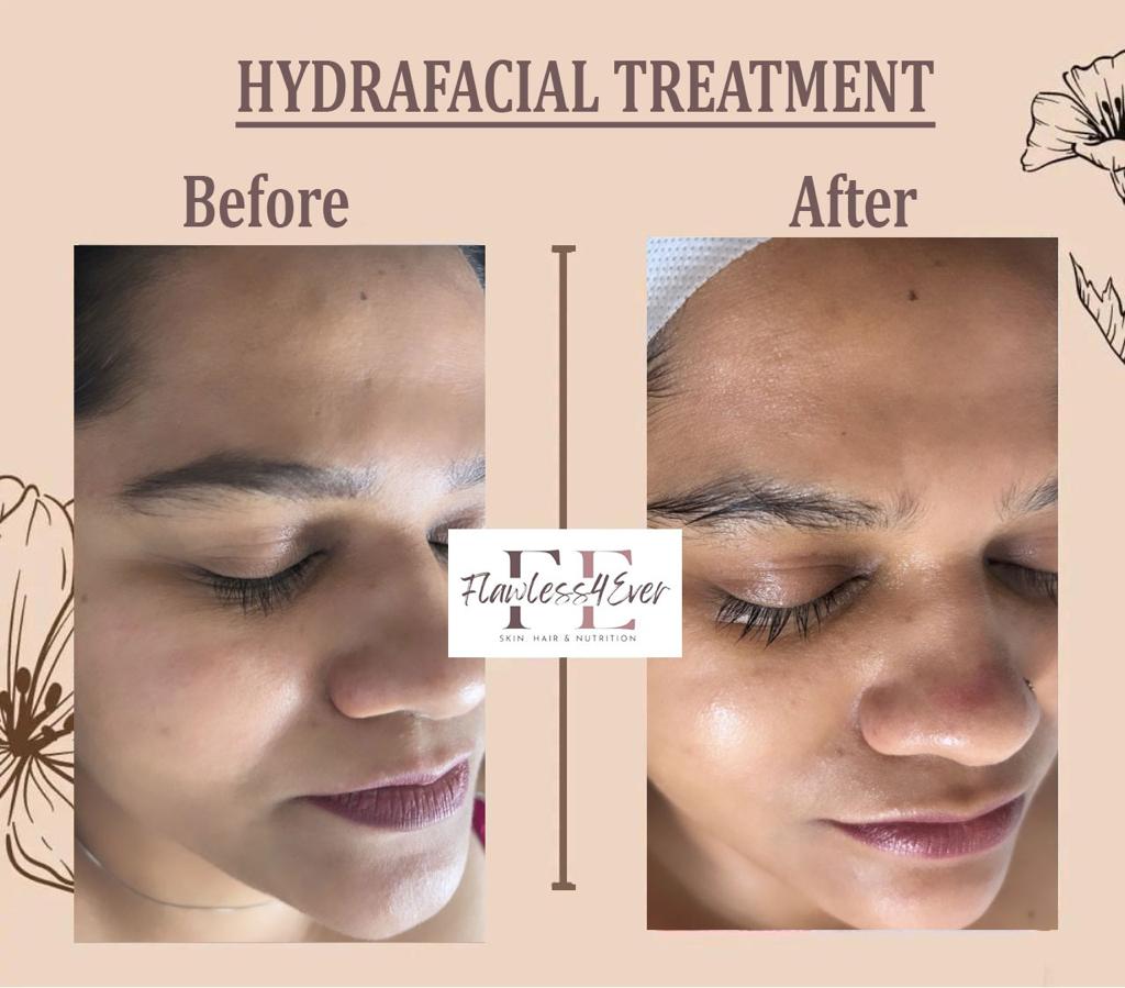 Hydrafacial Treatment in Pune