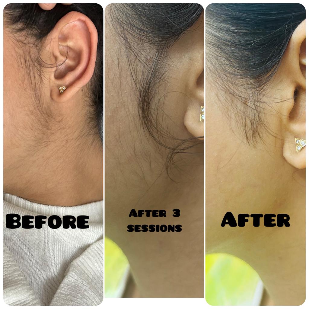 Before after image of Facial Laser Hair Removal in Pune