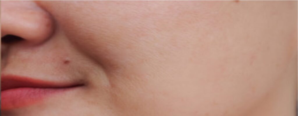 After - Best Medi Facials in Pune